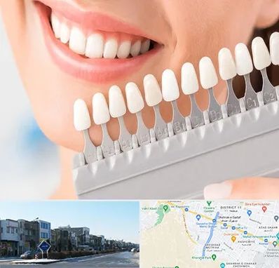 متخصص لمینت دندان در شریعتی مشهد