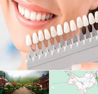 متخصص لمینت دندان در فومن