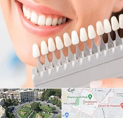 متخصص لمینت دندان در جهانشهر کرج 