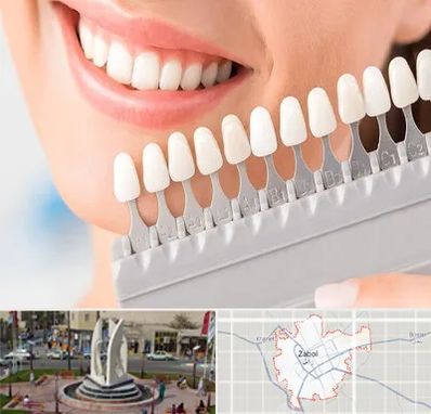 متخصص لمینت دندان در زابل
