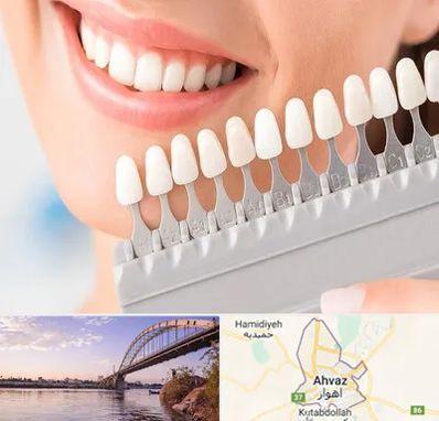 متخصص لمینت دندان در اهواز