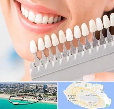 متخصص لمینت دندان در کیش