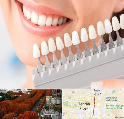 متخصص لمینت دندان در ولیعصر 