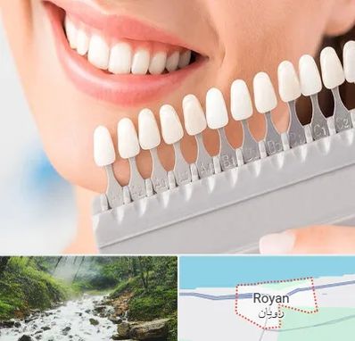 متخصص لمینت دندان در رویان