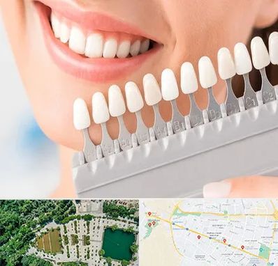 متخصص لمینت دندان در وکیل آباد مشهد