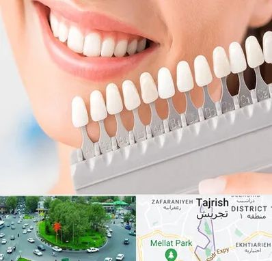 متخصص لمینت دندان در تجریش 