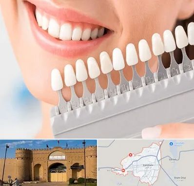 متخصص لمینت دندان در ایرانشهر
