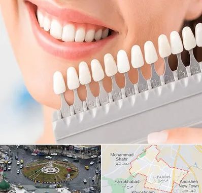 متخصص لمینت دندان در فردیس کرج 