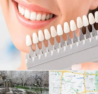 متخصص لمینت دندان در باغ فیض