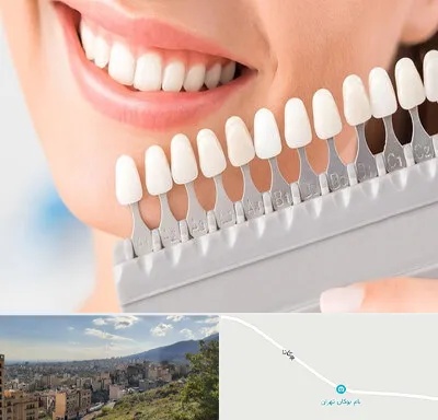 متخصص لمینت دندان در بوکان تهران