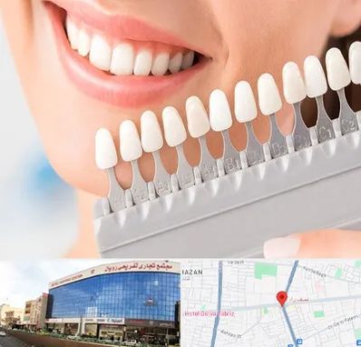 متخصص لمینت دندان در نصف راه تبریز