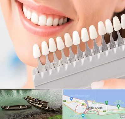متخصص لمینت دندان در بندر انزلی