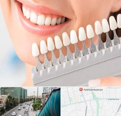 متخصص لمینت دندان در بلوار فرحزادی