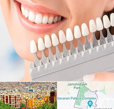 متخصص لمینت دندان در نیاوران 