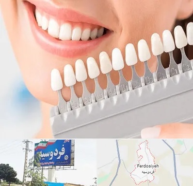 متخصص لمینت دندان در فردوسیه شهریار