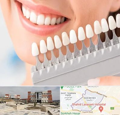 متخصص لمینت دندان در حکیمیه 