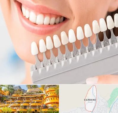 متخصص لمینت دندان در دربند