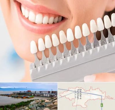متخصص لمینت دندان در بندر ترکمن