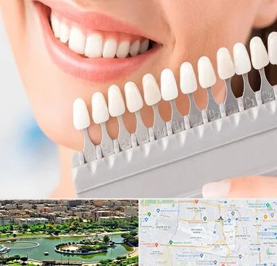 متخصص لمینت دندان در منطقه 9 تهران