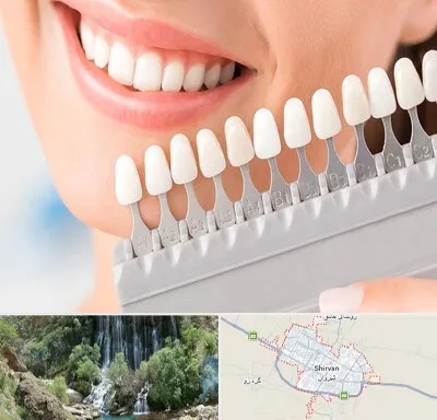 متخصص لمینت دندان در شیروان