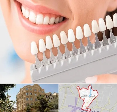 متخصص لمینت دندان در مینی سیتی