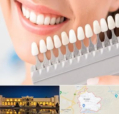 متخصص لمینت دندان در برازجان