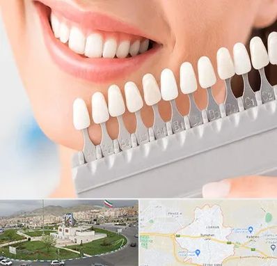 متخصص لمینت دندان در بومهن