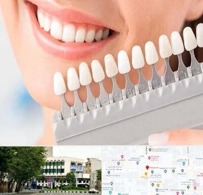 متخصص لمینت دندان در طالقانی