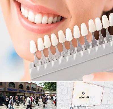 متخصص لمینت دندان در بازار تهران