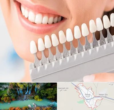 متخصص لمینت دندان در دورود