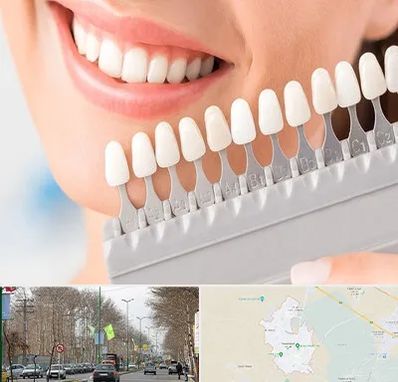متخصص لمینت دندان در نظرآباد کرج
