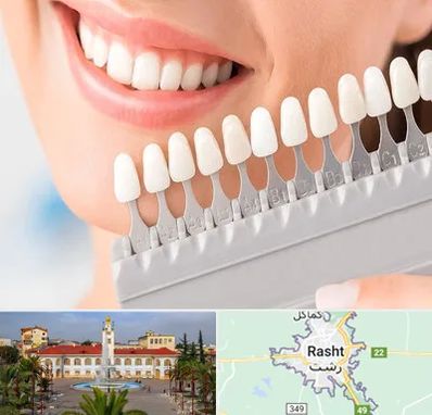 متخصص لمینت دندان در رشت