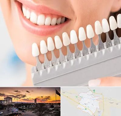 متخصص لمینت دندان در قوچان