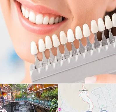 متخصص لمینت دندان در درکه