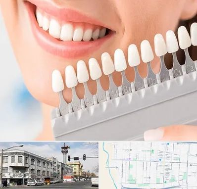 متخصص لمینت دندان در 17شهریور