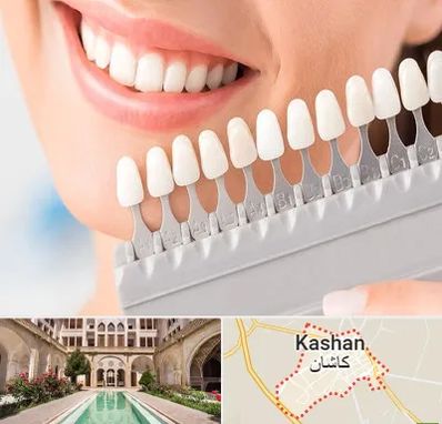 متخصص لمینت دندان در کاشان