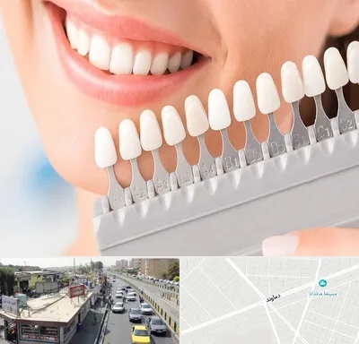 متخصص لمینت دندان در خیابان دماوند
