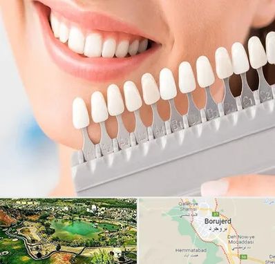متخصص لمینت دندان در بروجرد