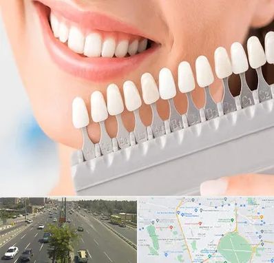متخصص لمینت دندان در منطقه 17 تهران
