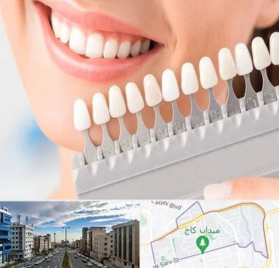 متخصص لمینت دندان در سعادت آباد 