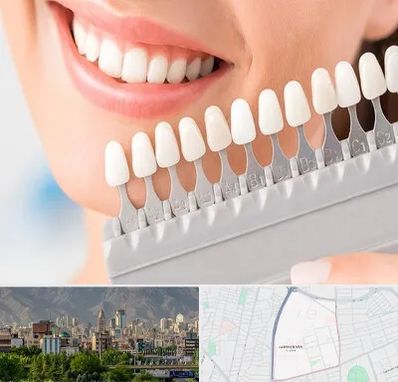 متخصص لمینت دندان در جمشیدیه