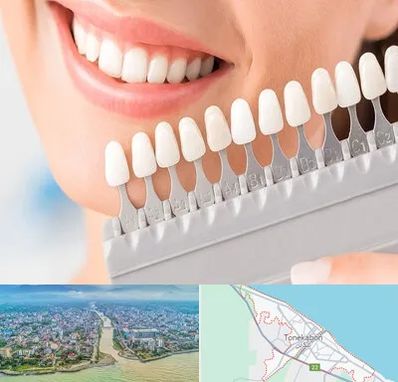متخصص لمینت دندان در تنکابن
