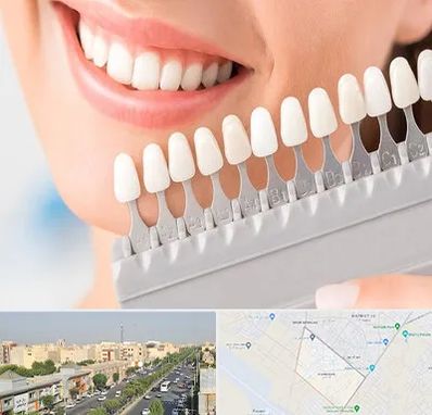 متخصص لمینت دندان در کیانمهر کرج