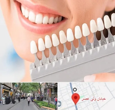 متخصص لمینت دندان در ولیعصر شهریار