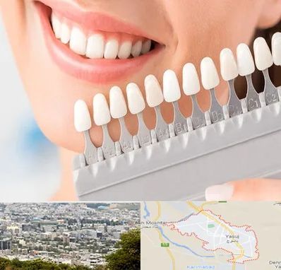 متخصص لمینت دندان در یاسوج