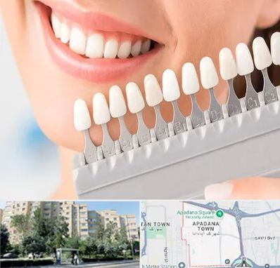 متخصص لمینت دندان در آپادانا