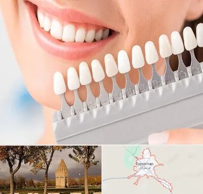 متخصص لمینت دندان در تویسرکان