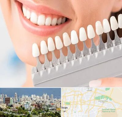 متخصص لمینت دندان در شرق تهران 