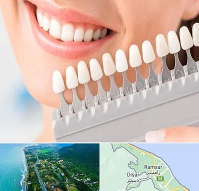 متخصص لمینت دندان در رامسر