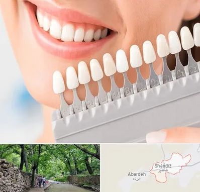 متخصص لمینت دندان در شاندیز مشهد